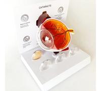 LSOAARRT Cataract Eye Model Eyeball (Glaucoma) Model Eye Disease Model Eyeball Pathology