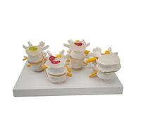 LSOAARRT Spine model, 4 stages of lumbar spine disease model intervertebral disc herniation model lumbar spine model