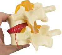 Lumbar Disc Herniation Demonstration Model Anatomical Human Spine Model Lumbar Spine Degenerative Disease Model 1.5X Teaching Model