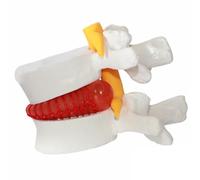 Lumbar Disc Herniation Model 1.5 Times Life Size Spine Model Portable Anatomical Human Lumbar Spine for Medical, Teaching, Learning and Scientific PresentationsLumbar Disc Herniation