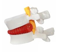 Lumbar Disc Herniation Model 1.5 Times Life Size Spine Model Portable Anatomical Human Lumbar Spine for Medical, Teaching, Learning and Scientific Presentations