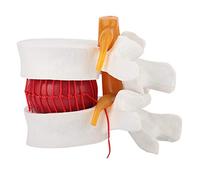 Lumbar Disc Herniation Model, Enlarged Interactive Anatomical Spine Demonstration Teaching Aid for Education Clinical Training PVC 1 5X L4 L5 Model 1 Piece