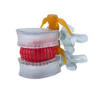 Lumbar Disc Herniation Model Movable Spine for Demonstrating Pathological Disc Vertebra with Nerves with Hips