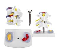 Lumbar Model,Human Lumbar Disc Herniation Model,Anatomical Lumbar Disc Herniation Demonstration Model Human Spine School