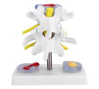Lumbar Spine Degeneration Model, Lumbar Spine Anatomical Model, Human Anatomical Lumbar Disc Herniation Model For Doctor's Office And Classrooms Medical Study Supplies