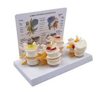Lumbar Spine Lesion Model, 4-Stage Vertebrae Anatomy Teaching Aid with Explanation Card for Medical Education