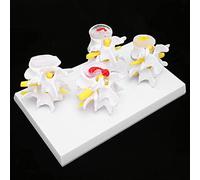 Lumbar Vertebrae Models 4-Stage Human Spine Model Normal Pathological Spine Osteoporosis Vertebrae Anatomical Model With