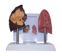 Lung Anatomy Model, Pathological and Normal Comparison with Smoking Lung, Durable PVC, Clear Texture for Presentations, Workshops, Educational Discussions