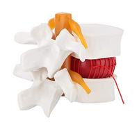 Luocute Human Lumbar Disc Herniation Model, 1.5X Magnification