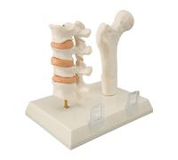 Luocute Osteoporosis Spine Model for Teaching Demonstration, Visualize Bone Density Professional Anatomical Osteoporosis Model with Stand for Educational Training Clinical and Teaching