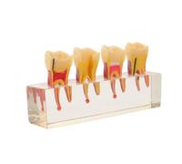 Lurrose Teaching Model and Interactive Removable Teeth with Caries Progression Visualized Resin Oral Anatomy Hands-on Practice for Primary Teeth for Clinics and Training Aid for Students
