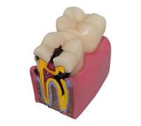 Luwecf Caries Tooth Model Teaching Prop 6 Times for Kids Studying Class Education