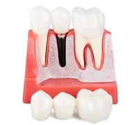 LVCHEN Dental Implant Model - 4 Times Crown Bridge Explanation Model Implant Analysis Tooth Model Removable Crown Cross-Section Demonstration for Study and Teaching