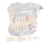 LVCHEN Transparent Dental Implant Teeth Model - Transparent Disease Teeth Model Pathological Tooth Model with Removable Teeth for Dental Study and Education