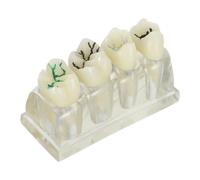 MAGICLULU Oral Caries Teeth Model for Patient Education and Clinical Demonstration, Sturdy Abs Material Educational Model Suitable for Assistants and Practitioners in Dental Teaching