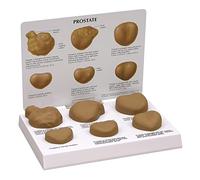 Male Contrast Pathological Prostate Anatomy Model - Anatomical Model Of Human Organ Study And Anatomical Models Of Teaching