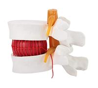 Malloy 1:1.5 Human Lumbar Disc Herniation Demonstration Model of Lumbar Vertebral Spine Model for Human Anatomy
