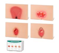 MedEduQuest Decubitus Ulcer Wound Care Model, Bedsores Model, Pressure Injury Model for Medical Training Practice, 4 Stages