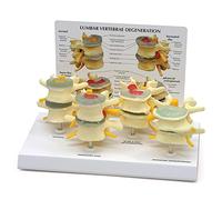 Medical Lumbar Spine Normal Lesion Combination Model Spine Model Human Body Anatomy Replica of Four-Stage Vertebrae Cond