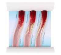 Mipcase Dynamic Plastic Blood Vessel Model for Medical Teaching, Anatomical Vascular Model with Blood Lipid Comparison, Educational Science Tool for Human Anatomy Studies