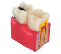 Mobestech Caries Tooth Teaching Model Resin Comparative Study Tool for Education Patient and Student Oral Health Learning