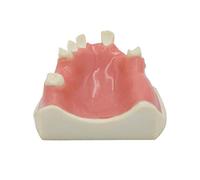 Model For Missing Dental Implants In The Upper Jaw, Model For Oral With Soft Gums, Dental Implant Practice, Medical Educational Aid