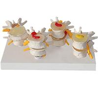 Models Anatomy Model, Educational Model The Diseased Model of Vertebrae Human Lumbar Vertebral Spine Anatomy Model Lumbar Lesion Model Anatomical Disc Herniation Model Spine Anatomy Model,Me