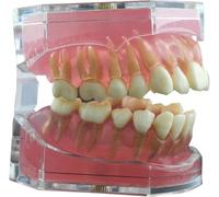 Moldable False Teeth,Dentures False Teeth,Dental Implant Teeth Model,with Soft Gum and Extractable Removable Resin Teeth for Practice and Teaching