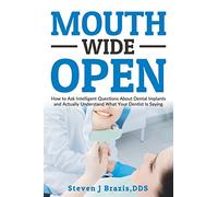 Mouth Wide Open: How To Ask Intelligent Questions About Dental Implants and Actually Understand What Your Dentist Is Saying