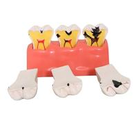 Muteitt Dental Caries Teeth Model,Dental Anatomy Education Tooth Model, 4 Times Dental Caries Teaching Tool for Dentists Teachers Students