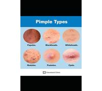 Natural Ways to Help Heal Acne and Pimples