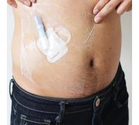 NBNBN Shower Shield For Peritoneal Dialysis Patients, Transparent Film Wound Dressing, Waterproof Disposable Moisture Barrier Barrier Wound Cover