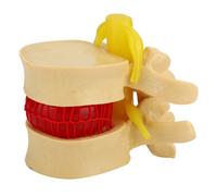 NEW 1:1.5 Lumbar Disc Herniation Demonstration Model Study Learn Human Spine