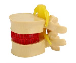 NEW 1:1.5 Lumbar Disc Herniation Demonstration Model Study Learn Human Spine