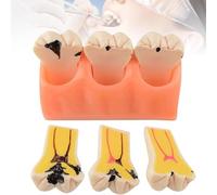 NGARY Dental Caries Evolution Model, 4X Magnification Dental Teeth Caries Model, Decomposition Of Tooth Decay And Caries Process, Tooth Pathology Display For Teaching Learning