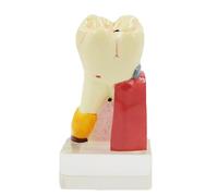 NGARY Dental Comprehensive Pathological Model, Dental Lesions Model, 4X Dental Caries Tooth Model, Shows Common Parts Of Dental Caries And Process Of Evolution Of Dental Caries for Dental Education