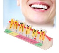 NGARY Teeth Anatomy Education Model, Dental Caries Developing Model, Dental Tooth Pathology Display Tooth, Shows The Whole Process Of Caries Development, for Teeth Typodont Study & Education