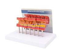 Nicear Medical Atherosclerosis Model Artery Pathology Artery Anatomical Elderly Blood Vessel Structure Model Teaching Supplies