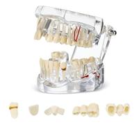 Nihcora Dental Typodonts Implant Teeth Model with Removable Teeth Dentist Standard Tooth Demonstration
