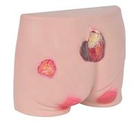 Nursing Bedsores Model, Four-Stage Wound Care Simulation, Soft Silicone Material for Training and Assessment
