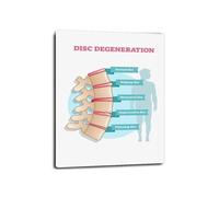NWPNLXEA Degenerative Disc Disease Poster Stages of Spinal Anatomy Chart Illustration Wall-Art for Hospital Clinic Office Decor Unframed,16X24inch(40X60cm)