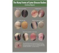 NWPNLXEA Lyme Disease Prevention Poster Stop the Spread Self Protection Guide Wall-Art Canvas Print for Bedroom Living Room Decor Unframed,16x24inch(40x60cm)