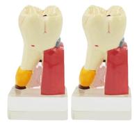 NZPOST 4X Enlarged Caries Teaching Model Dental Caries Tooth Model Dental Care Teeth Medical Model Best Teaching Aid (2)
