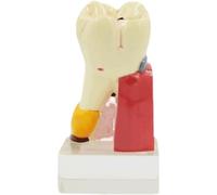 NZPOST 4X Enlarged Caries Teaching Model Dental Caries Tooth Model Dental Care Teeth Medical Model Best Teaching Aid (1)
