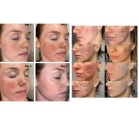 One Session Chemical Peel Facial Cleansing