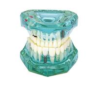 Oral Implant & Disease Study Model: Prosthetic Restoration & Bridge Display