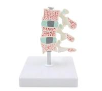 Osteoporotic Lesion Anatomy Model, Human Skeletal Osteoporosis Lesion Model with Display Base, 3-Stage Vertebral Evolution Comparison for Classroom Demonstrations.