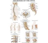 Palace Learning Disorders of the Spine Anatomy Poster - Laminated Spinal Disorders Anatomical Chart - 18" x 24"