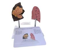 Paociuro Smoker'S Lung Model Healthy Lung Model with Pathological Respiratory System Disease Lungs