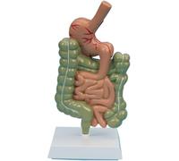 Pathological Digestive System Model, Human Colon Lesion Model, Gastrointestinal Large Intestine Lesion Model for Intestinal Disease Medical Research.
